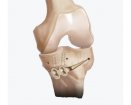 Arthrex iBalance HTO System | Used in High tibial osteotomy | Which Medical Device